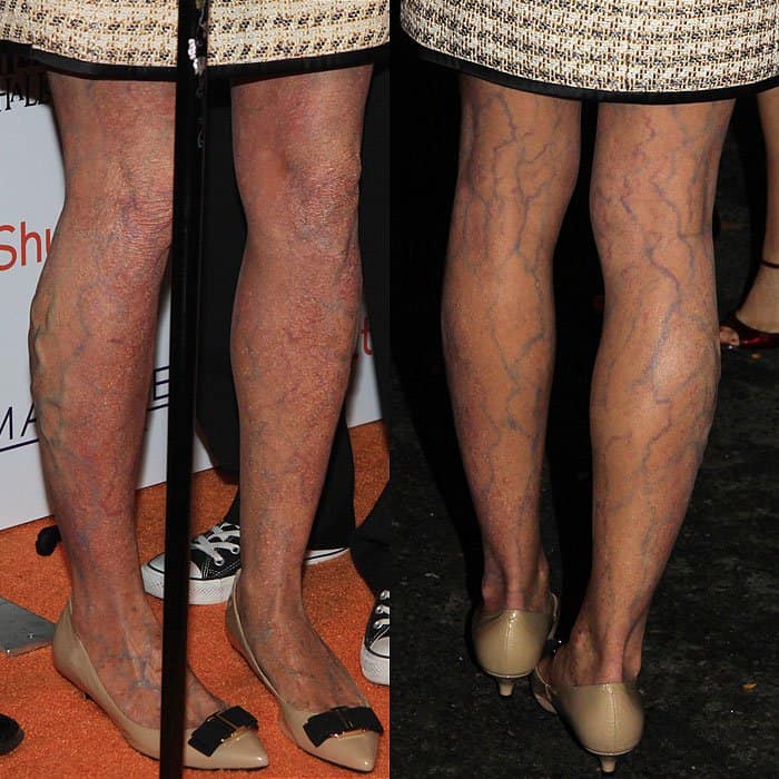 Heidi Klum's legs with spider veins and varicose veins