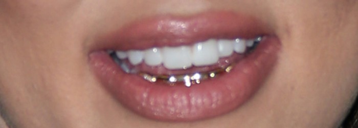 Khloe Kardashian shows off her expensive-looking gold grillz