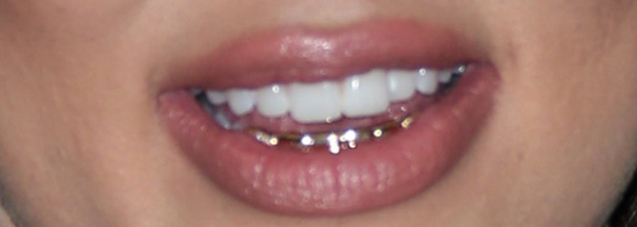 Khloé Kardashian shows off her expensive-looking gold grillz