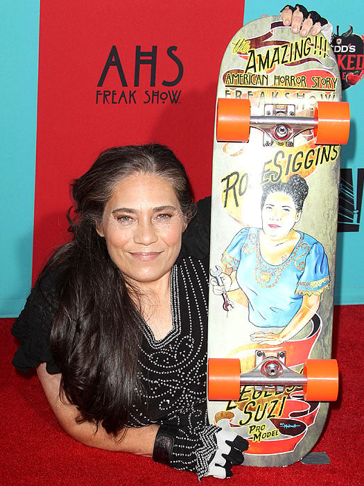 Rose Siggins, the woman who had to have both legs amputated as a child due to a genetic disorder known as sacral agenesis