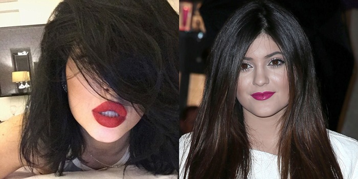 Kylie Jenner's lips before and after plastic surgery