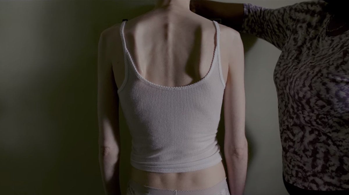 Lily Collins' emaciated-looking frame as 20-year-old college dropout Ellen in Netflix's To the Bone