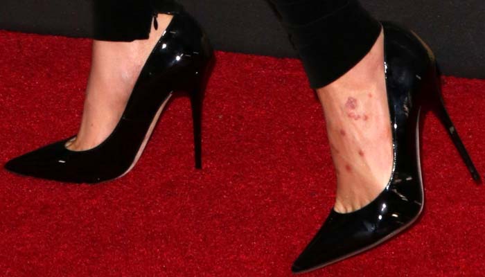 Bed bug bites? Cara Delevingne showcases some mean-looking pockmarks on her left foot