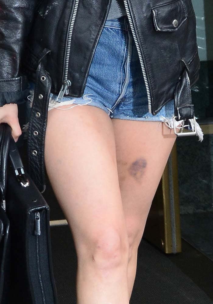 Lady Gaga shows off a massive bruise on her thigh in a pair of Levi's shorts