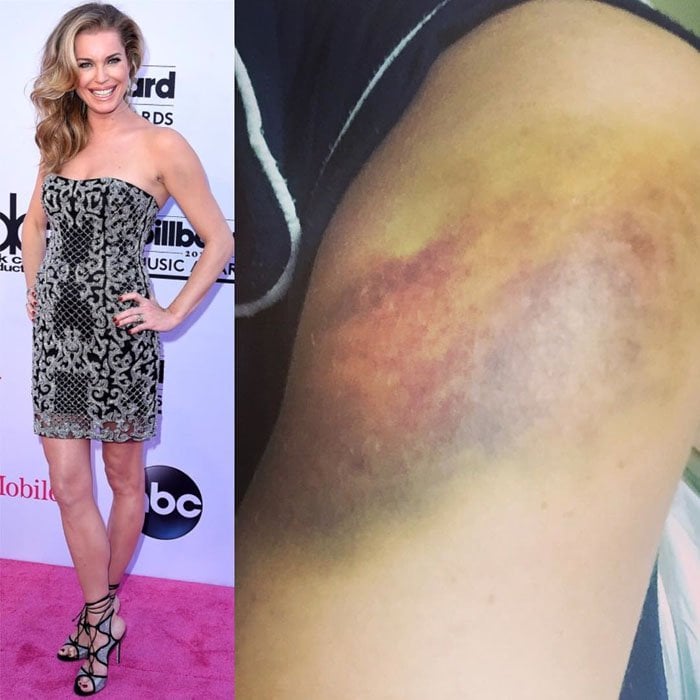 Rebecca uploaded a photo of her nasty bruise which had to be covered by her makeup artist for the BBMAs