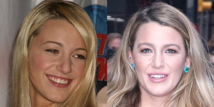 Blake Lively's nose in May 2005 (L) and in January 2020 (R)