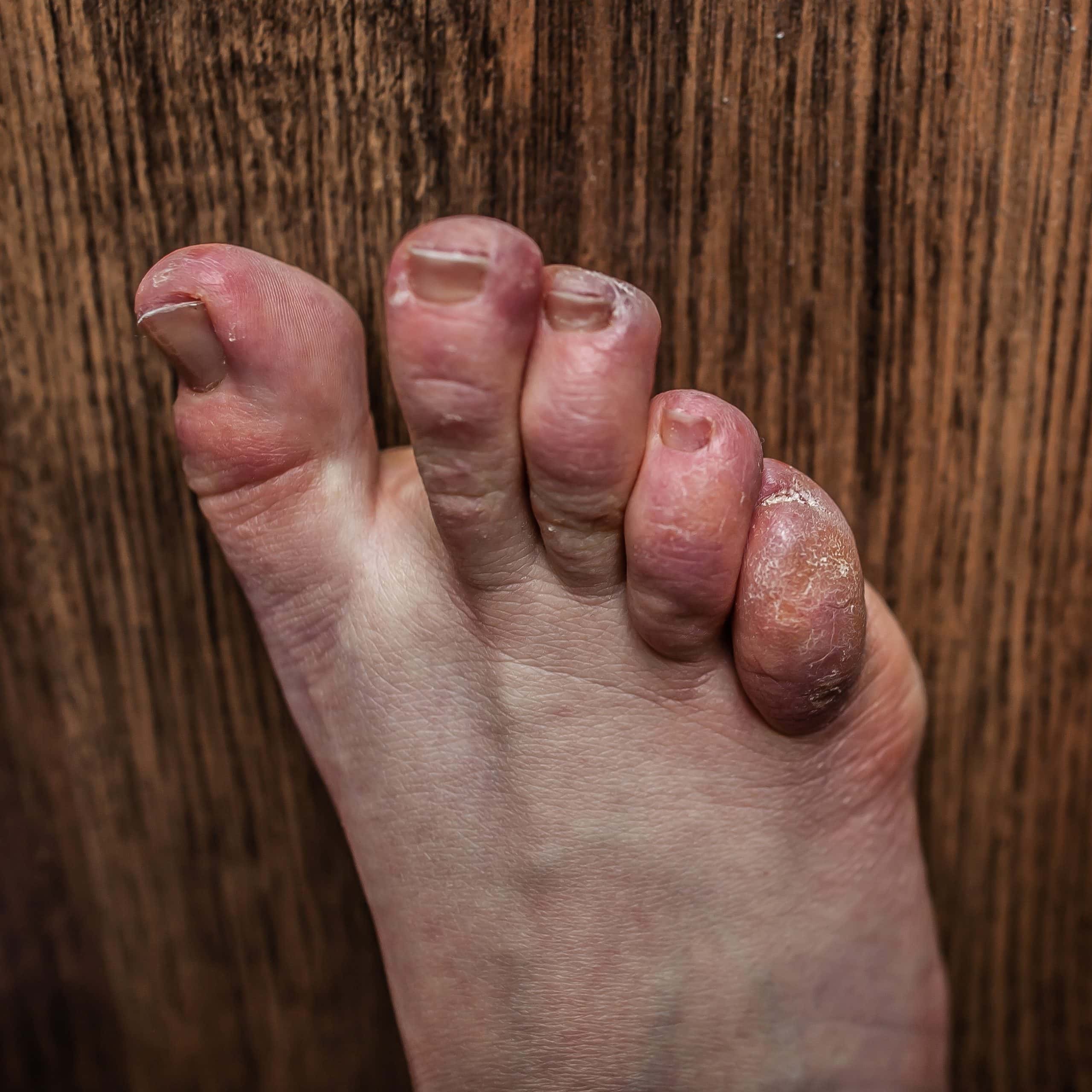 Foot with dry skin of a person with both Raynaud and Ehlers-Danlos (EDS) syndrome