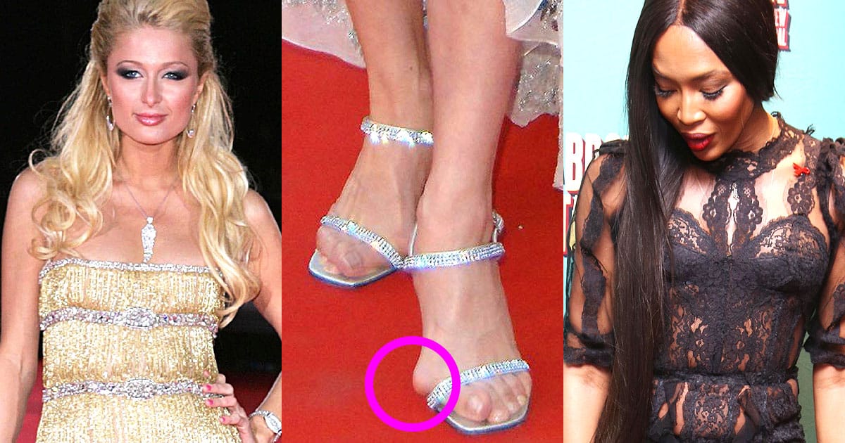 Celebrity Bunions: How to Prevent and Treat Bony and Lumpy Foot Deformities...