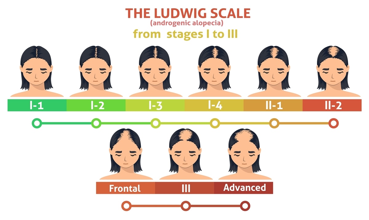 The Ludwig scale is a method of classifying female pattern baldness, also known as androgenic alopecia