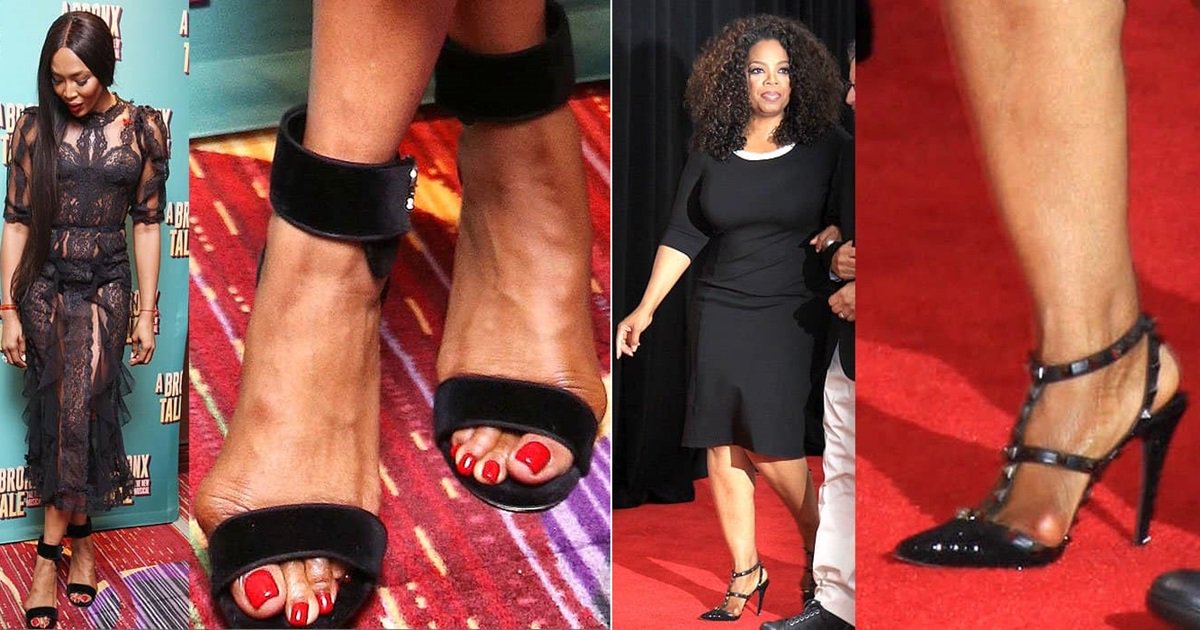 Celebrity Bunions: How to Prevent and Treat Foot Deformities