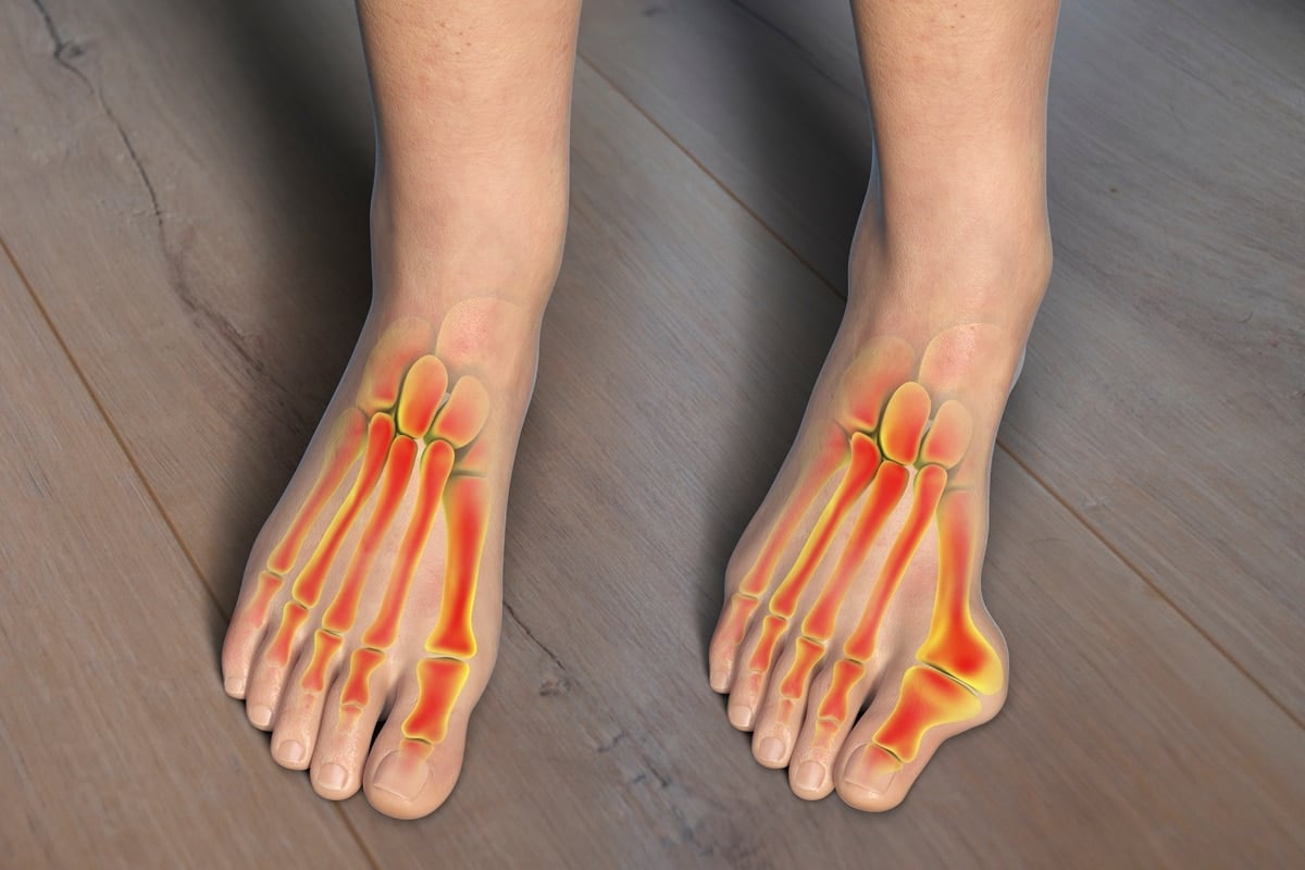 Comparison of a normal foot (left) and a foot with a bunion (right), showing the bony bump at the big toe joint, causing misalignment and inflammation