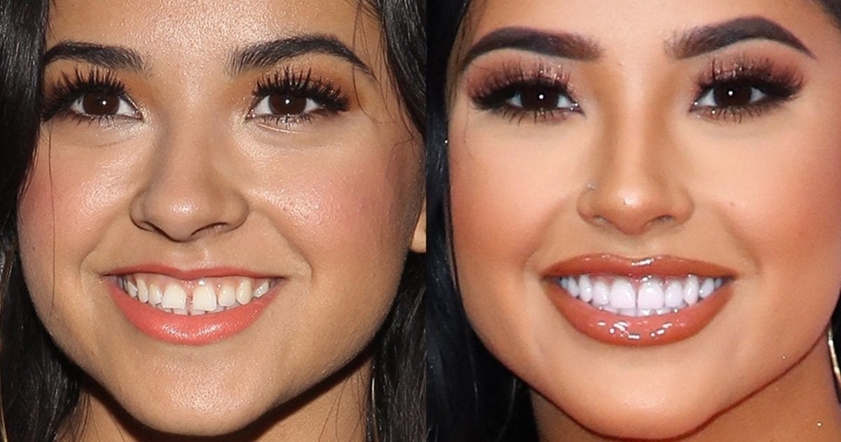 Becky g teeth gap before and after.