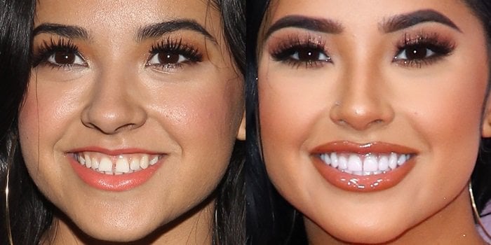 Becky G's trademark tooth gap and fixed teeth