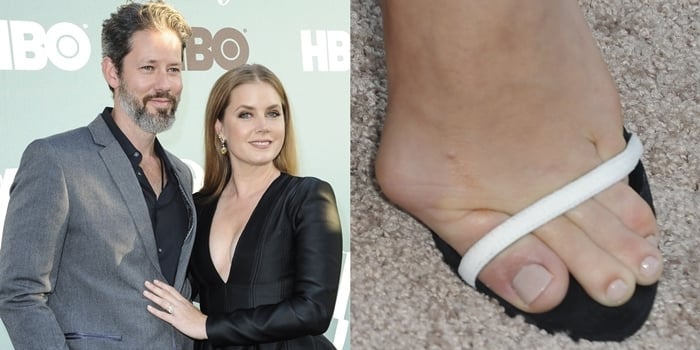 Amy Adams suffers from painful-looking bunions