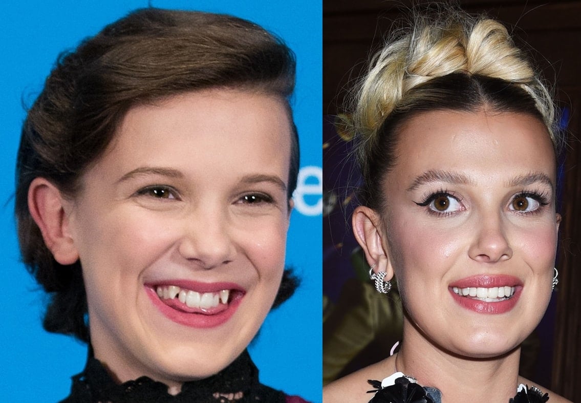 Millie Bobby Brown's teeth before and after she had them fixed