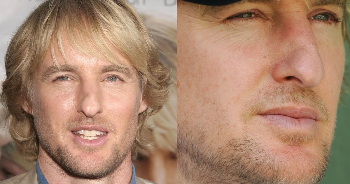 What happened to Owen Wilson's nose