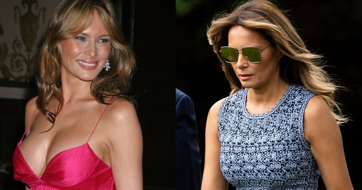 Melania Trump Denies Plastic Surgery: Breasts Before and After