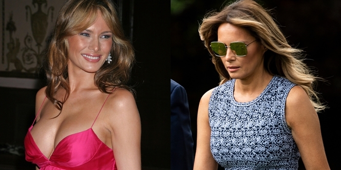 Melania Trump's breasts before and after rumored breast augmentation in 2005 (L) and in 2020 (R)