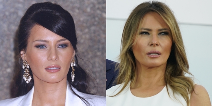 Face before and after rumored plastic surgery: Melania Trump in 2004 (L) and in 2020 (R)