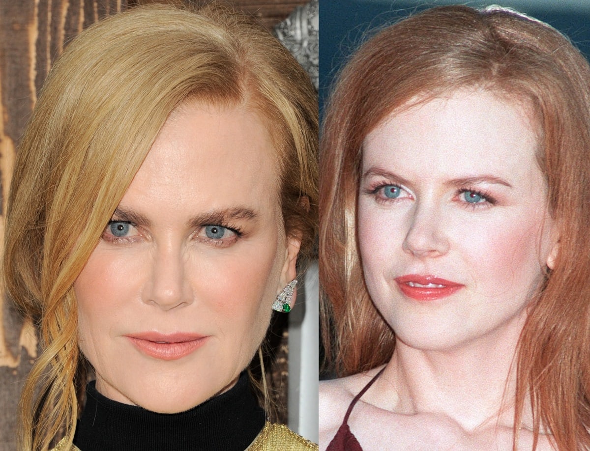 There are subtle differences in Kidman's face from 1999 to 2022, including smoother skin and fuller lips, suggesting the possibility of cosmetic procedures like Botox or fillers, although natural aging could also account for these changes