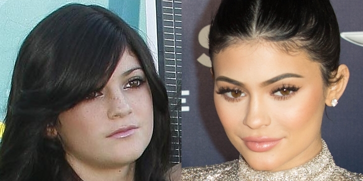 Pictured in 2009 (L) and 2017, Kylie Jenner denies ever having plastic surgery