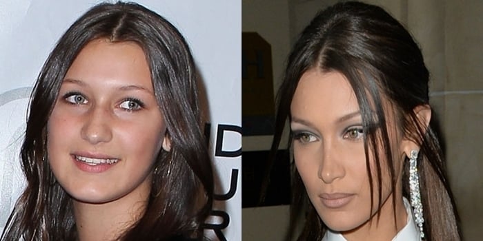 Bella Hadid's nose before and after rumored plastic surgery