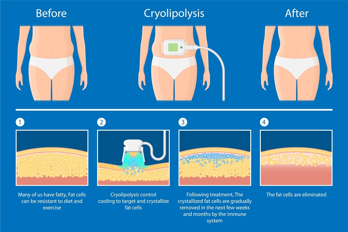 CoolSculpting is a controversial treatment to reduce fat using controlled cooling