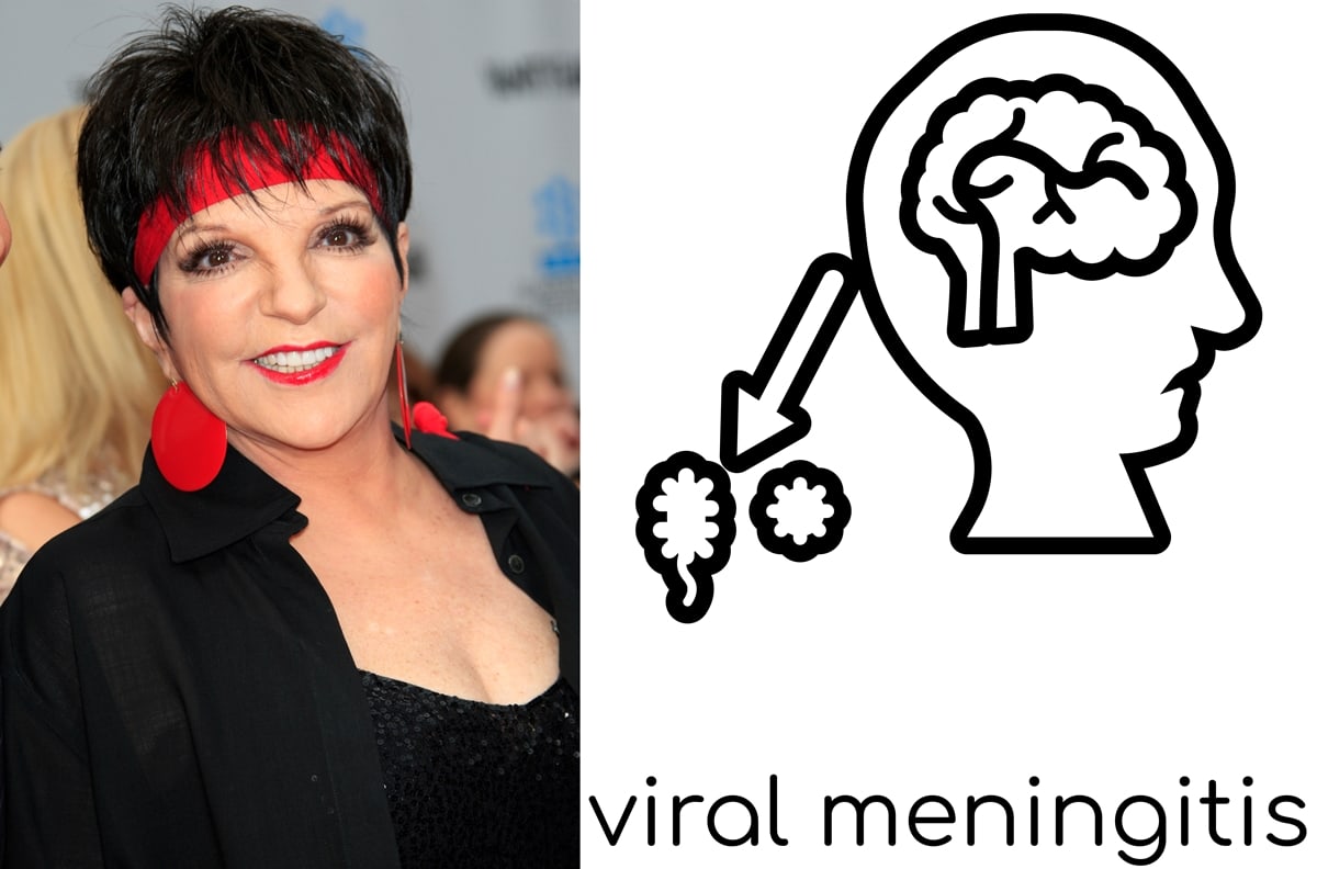 Liza Minnelli was diagnosed with viral encephalitis, which causes brain inflammation, in October 2020