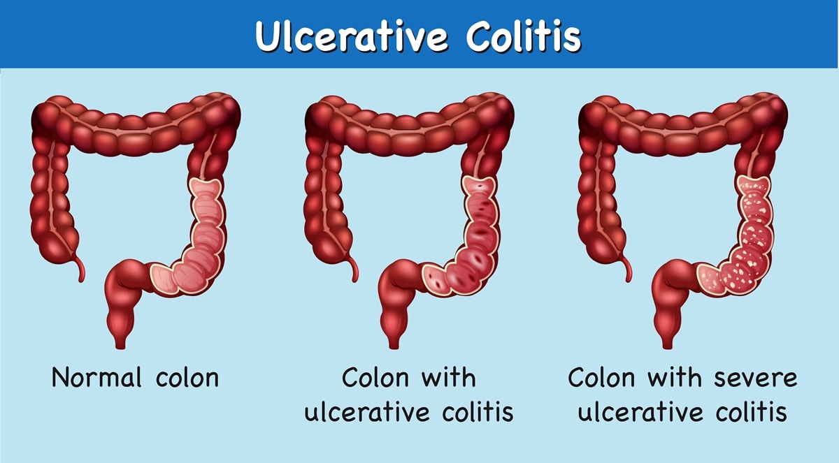 Tyler Stanaland had to stop surfing due to an inflammatory bowel disease called ulcerative colitis