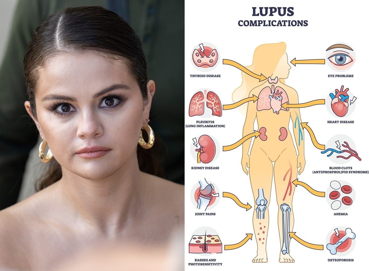 Singer Selena Gomez revealed in 2015 that she has lupus and underwent a kidney transplant at just 24 due to organ damage