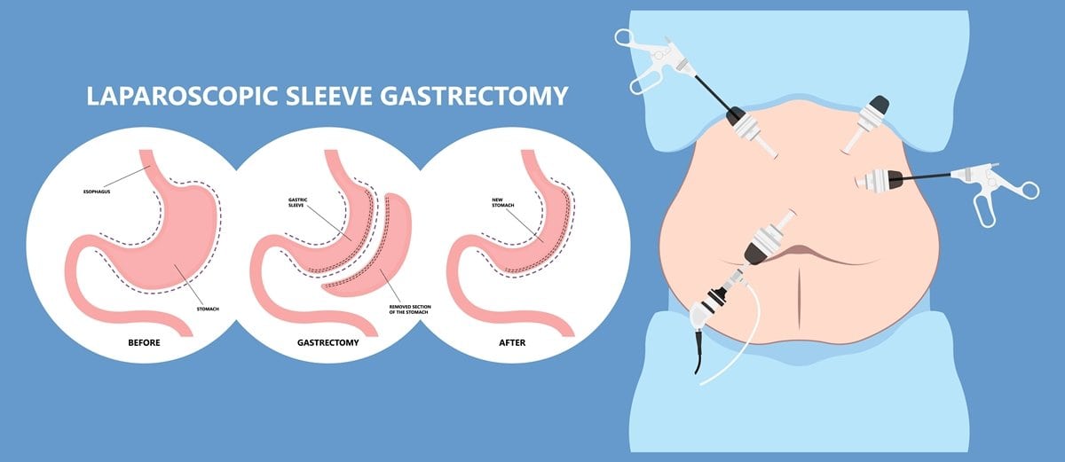 Gabourey Sidibe underwent laparoscopic bariatric surgery after she was diagnosed with Type 2 diabetes