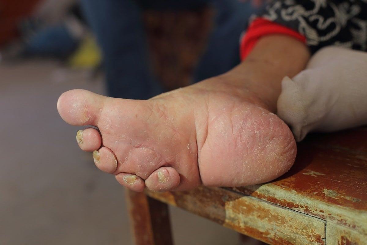 Foot binding maimed the feet of millions of Chinese women for centuries