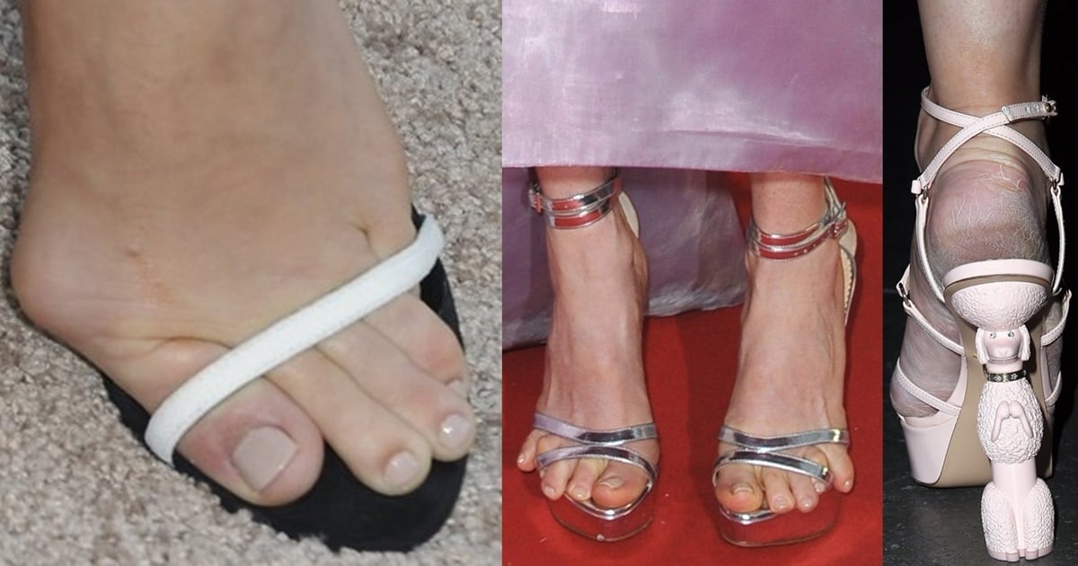 30 Celebs With Ugly Feet Crusty Toes and Nasty Toenails