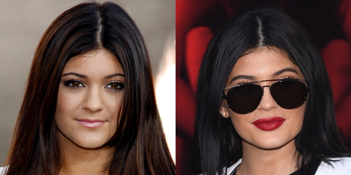 Kylie Jenner denies ever having plastic surgery on her face and claims that the only procedure she had was lip fillers, adding that people often assume she had extensive surgery due to misconceptions and false rumors about her insecurities