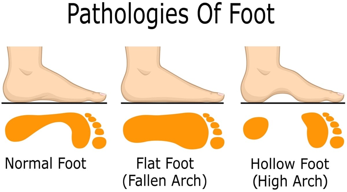 If you can only see your heel, the ball of your foot, and your toes in your footprint, it indicates that you have high arches